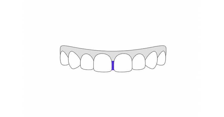 Cerrar espacio entre dientes sin ortodoncia