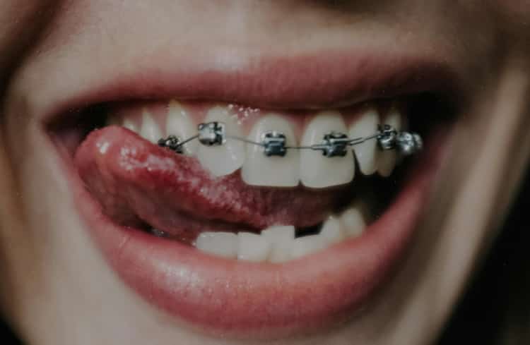 Brackets Metálicos
