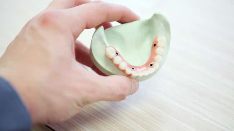 Puente Dental sobre Implantes