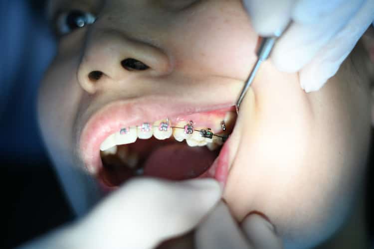 Empastes (Restauraciones) Dentales