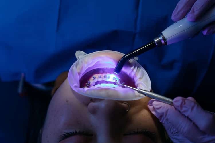 Blanqueamiento Dental Clínico Profesional