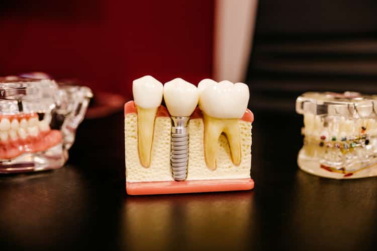 Implante Dental Unitario