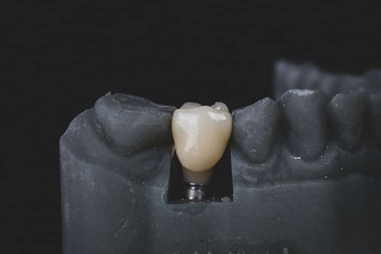 Prótesis sobre Implantes