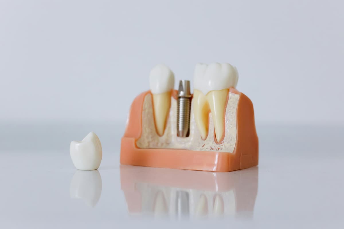 Implantes Dentales en Odéntitus