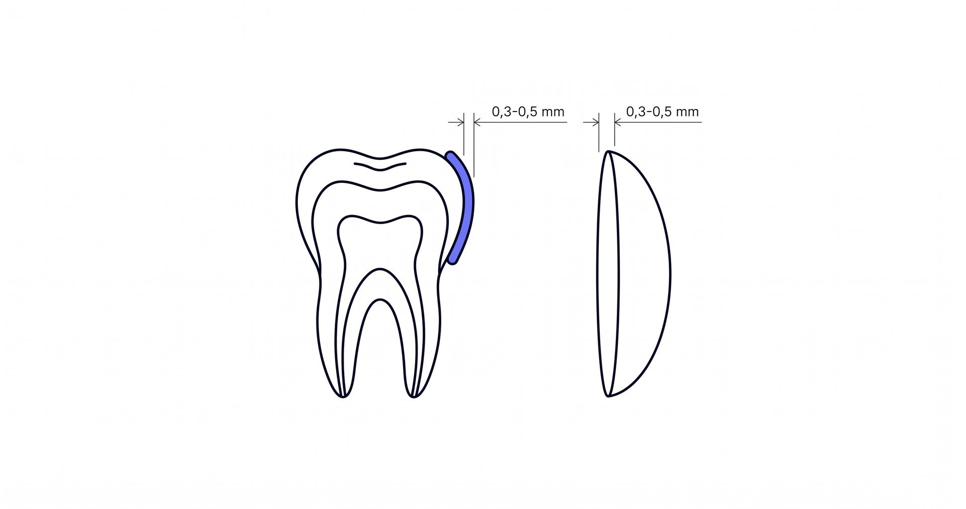 Diagrama del grosor de una lámina ultrafina comparado con una lentilla