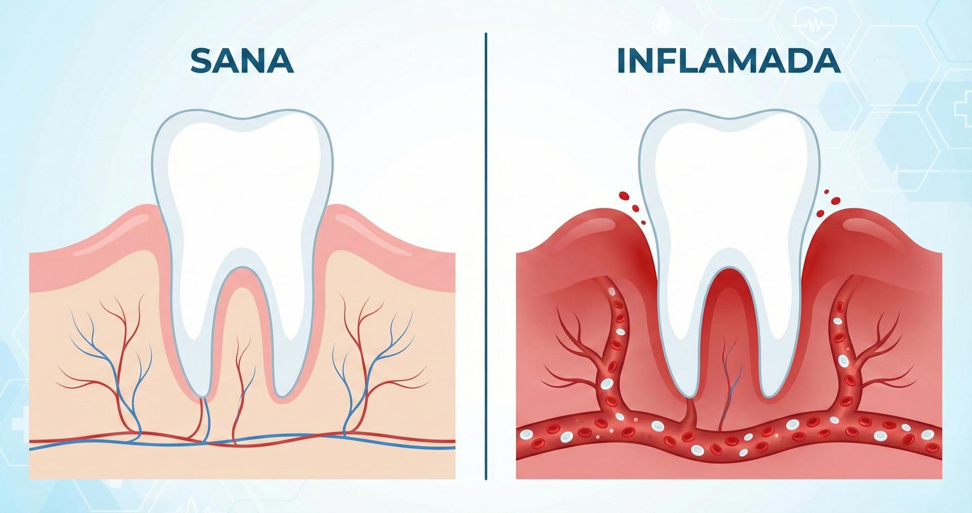 Diagrama anatómico que compara una encía sana rosa con una encía inflamada y roja mostrando vasos sanguíneos dilatados.