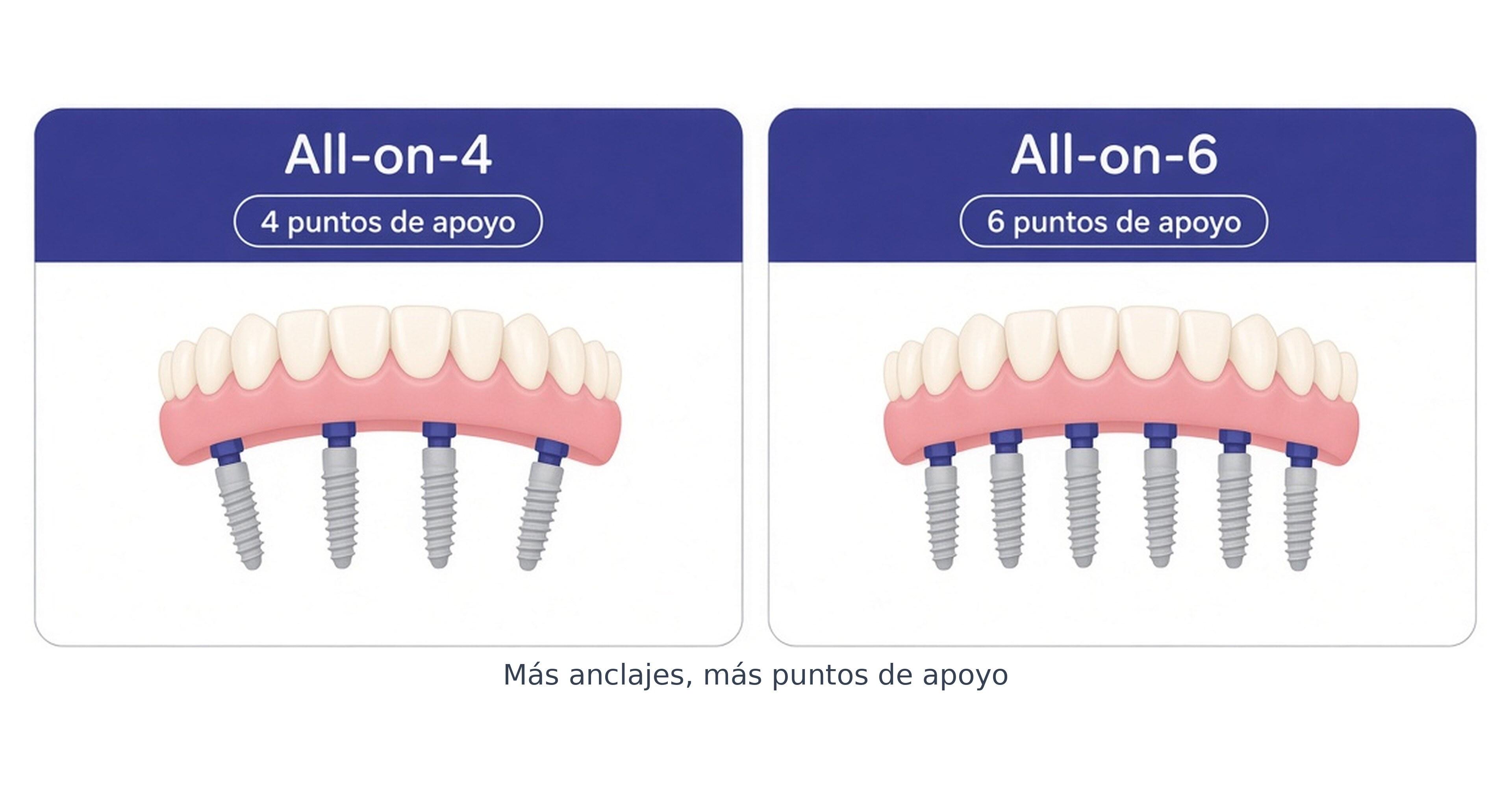 Comparativa de dentadura fija sobre implantes: All-on-4 (4 puntos de apoyo) frente a All-on-6 (6 anclajes)