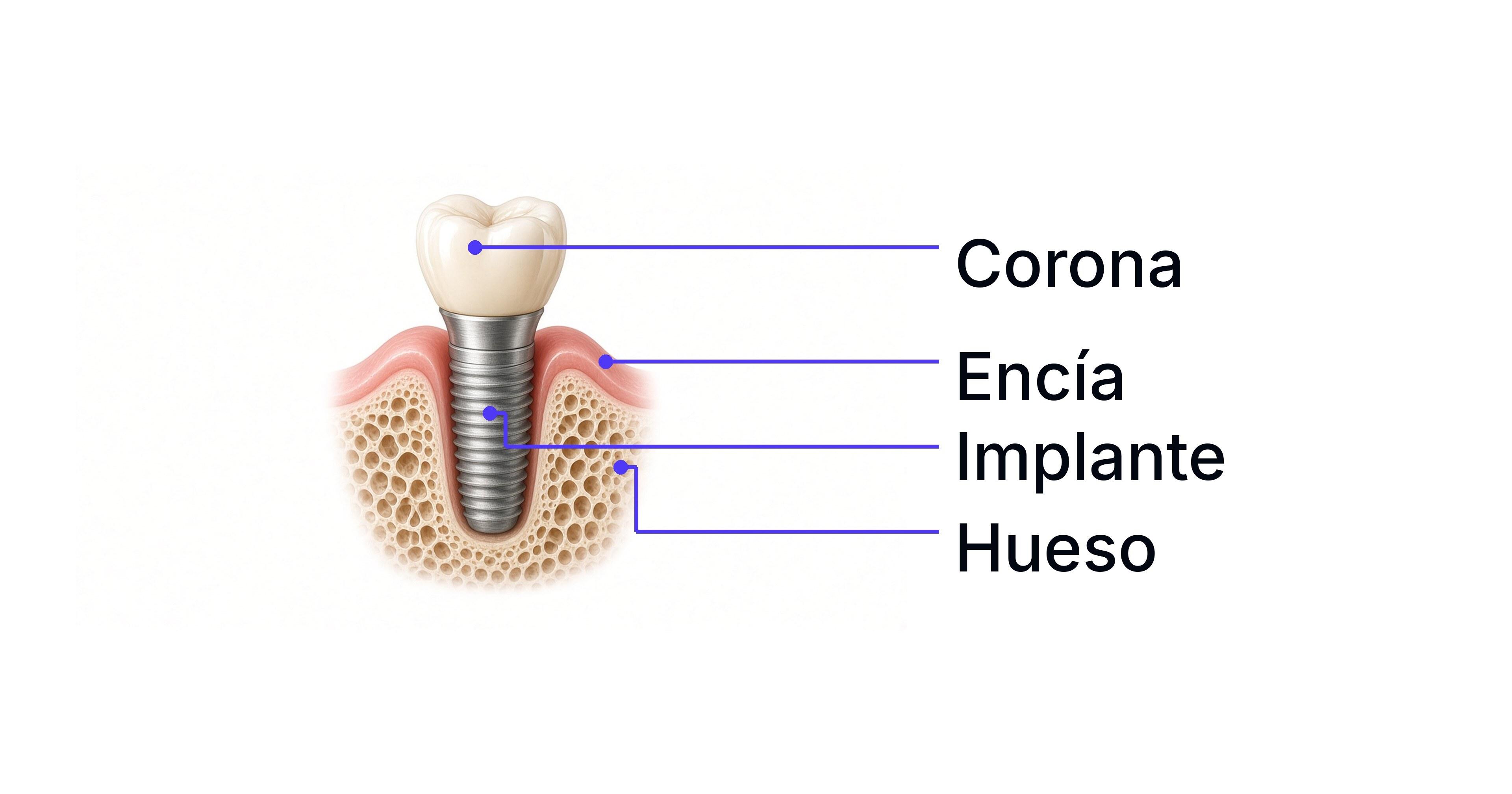 Corte de implante: corona, encía, implante y hueso en contacto