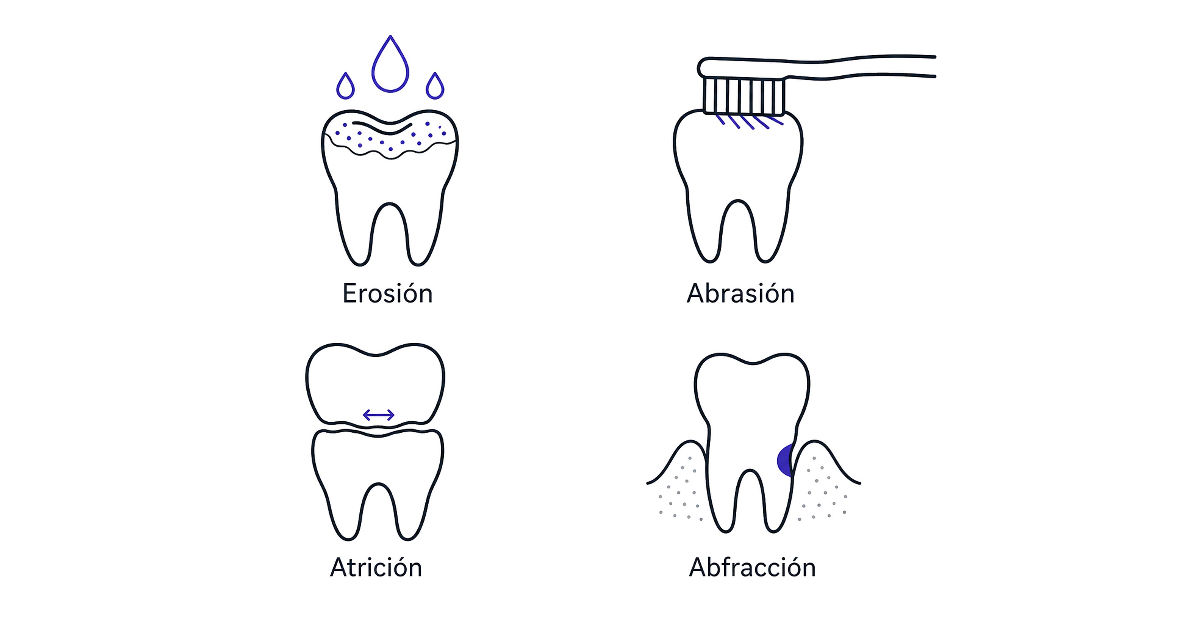 Diagrama de erosión, abrasión, atrición y abfracción, los cuatro tipos de desgaste del esmalte