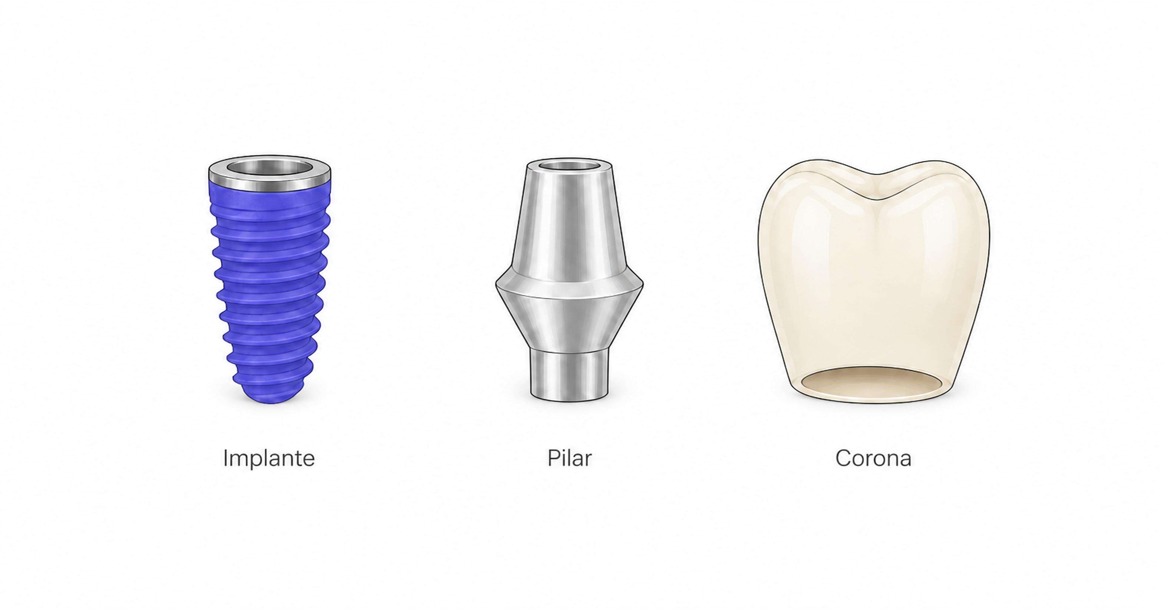 Diagrama compacto de un implante dental en tres partes: implante, pilar y corona
