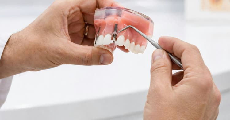 ¿Se rechaza un implante dental? Qué es la Osteointegración y qué no es un rechazo