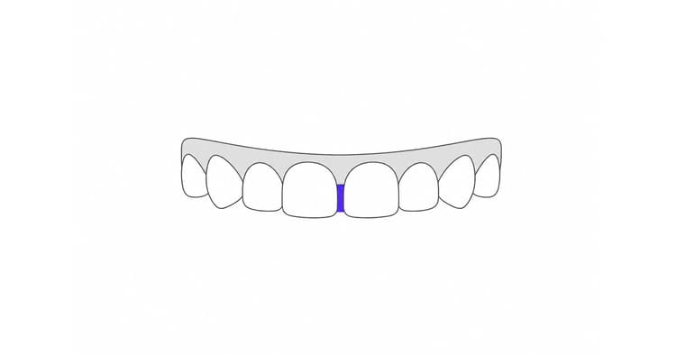 Cerrar espacio entre dientes sin ortodoncia