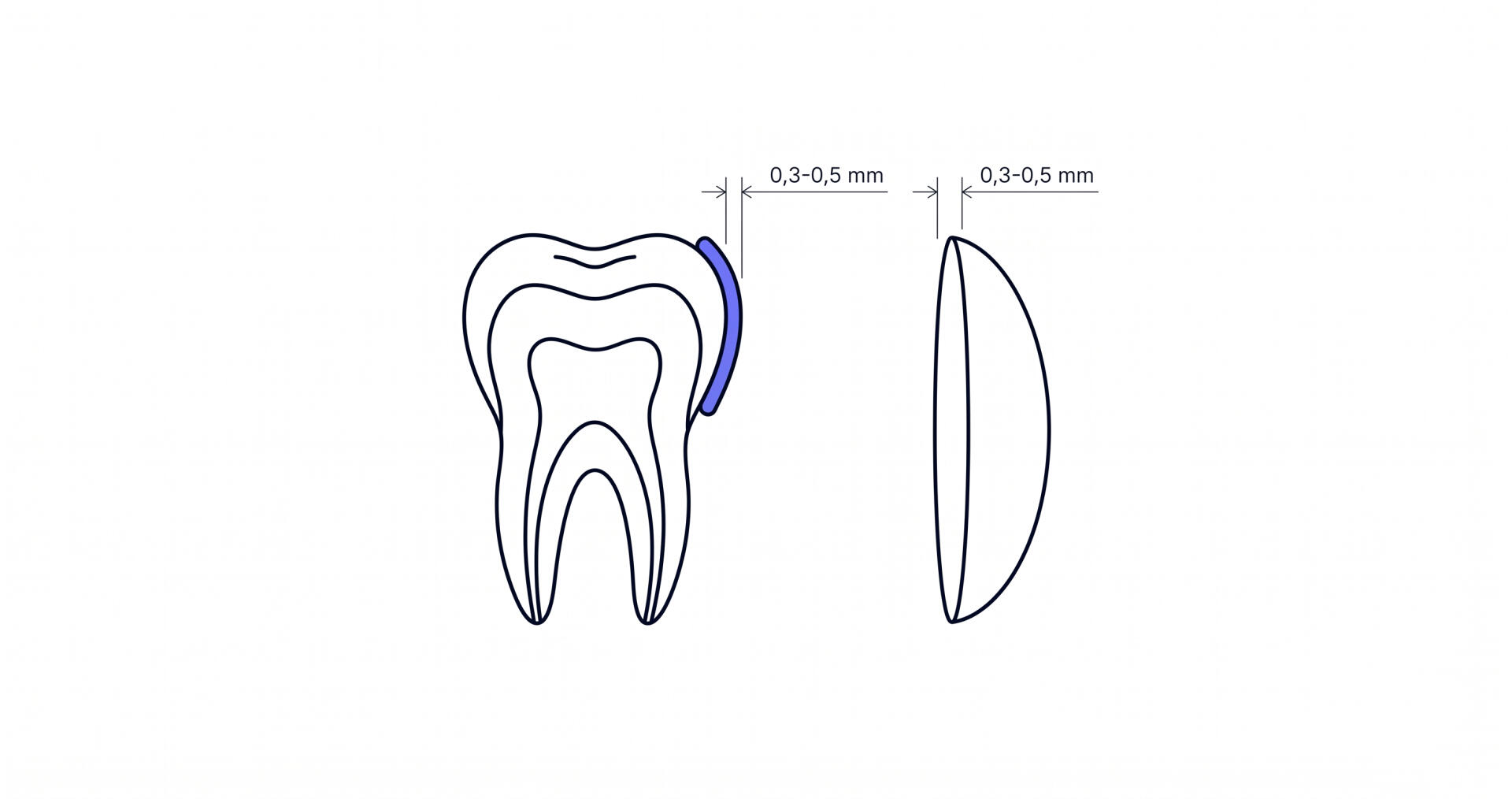 Diagrama del grosor de una lámina ultrafina comparado con una lentilla