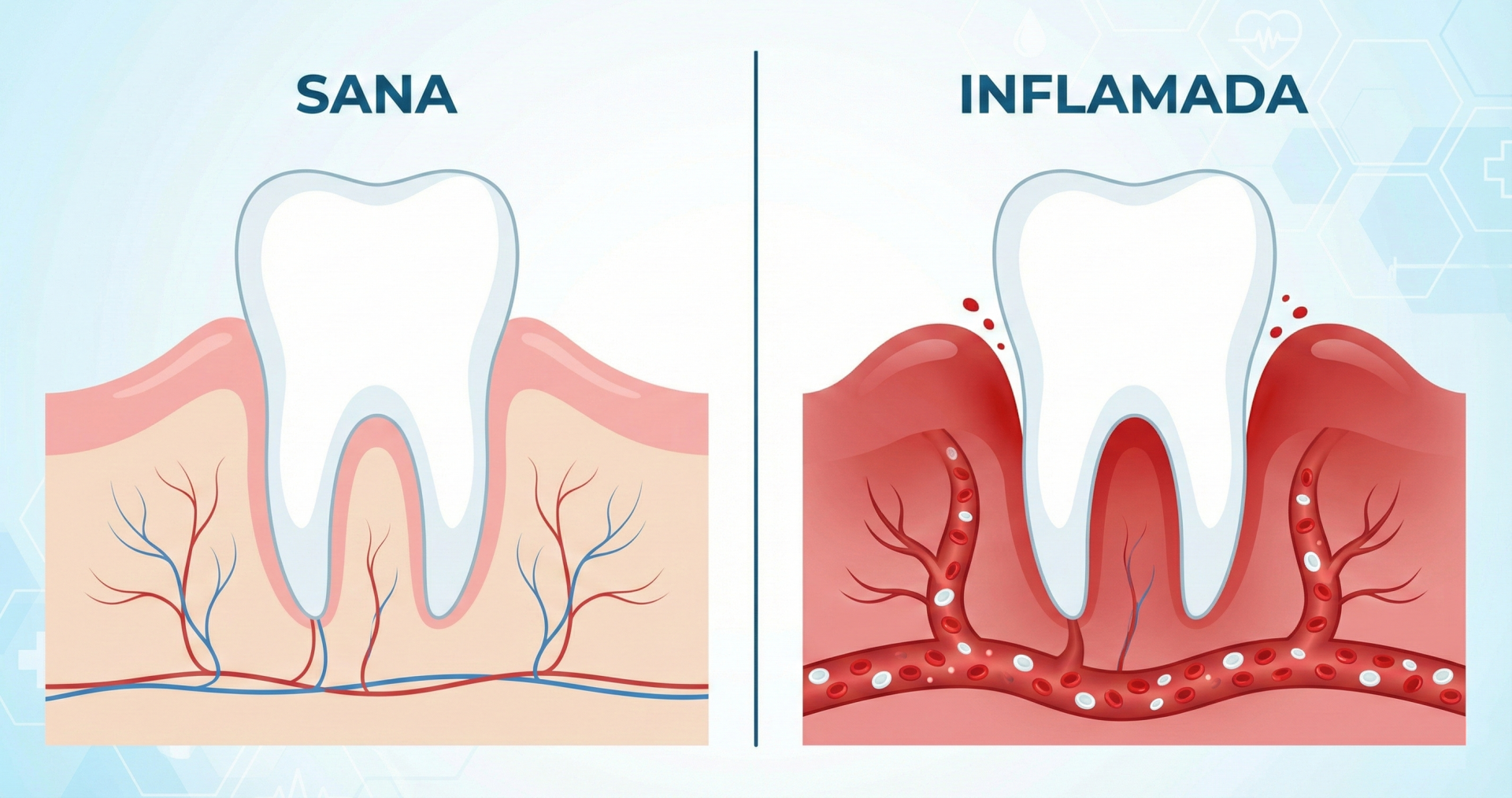 Diagrama anatómico que compara una encía sana rosa con una encía inflamada y roja mostrando vasos sanguíneos dilatados.