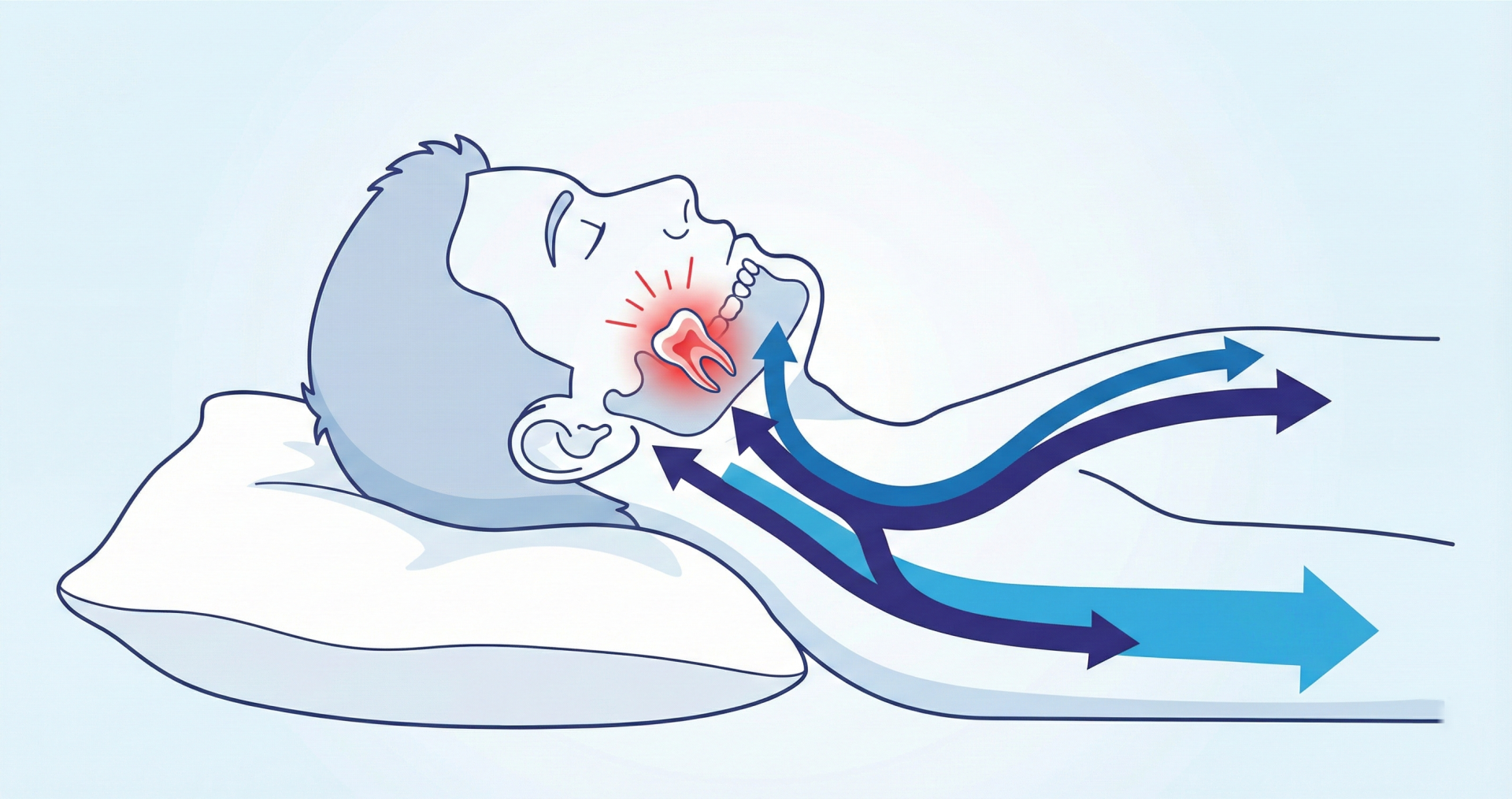 Ilustración de la presión sanguínea dental al estar acostado.