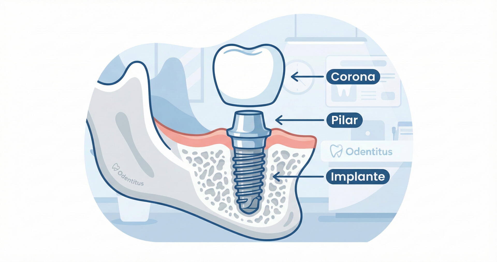 Esquema de las partes de un implante dental: tornillo, pilar y corona.